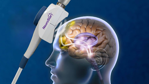 What does TMS treatment do? The NeuroStar coil delivers magnetic pulses deep into targeted brain regions.
